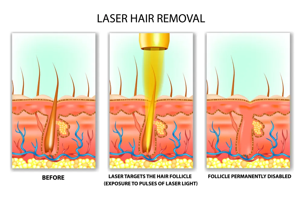 Laser hair reduction at Skin Pixel