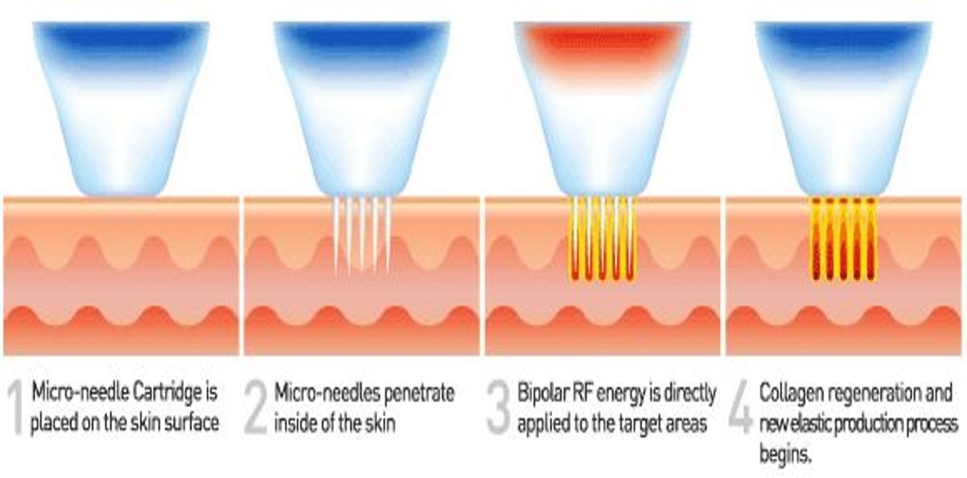 MNRD at Skin Pixel